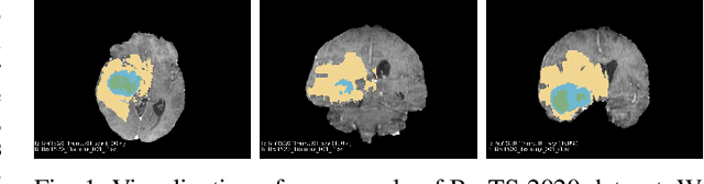 Figure 1 for A4-Unet: Deformable Multi-Scale Attention Network for Brain Tumor Segmentation