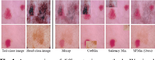 Figure 1 for Saliency-guided and Patch-based Mixup for Long-tailed Skin Cancer Image Classification