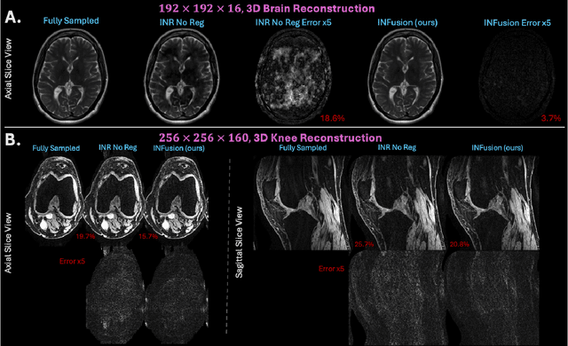 Figure 4 for INFusion: Diffusion Regularized Implicit Neural Representations for 2D and 3D accelerated MRI reconstruction