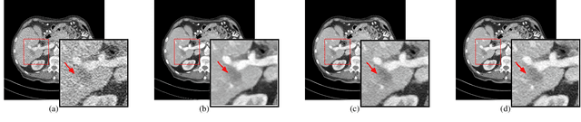 Figure 4 for D-PerceptCT: Deep Perceptual Enhancement for Low-Dose CT Images