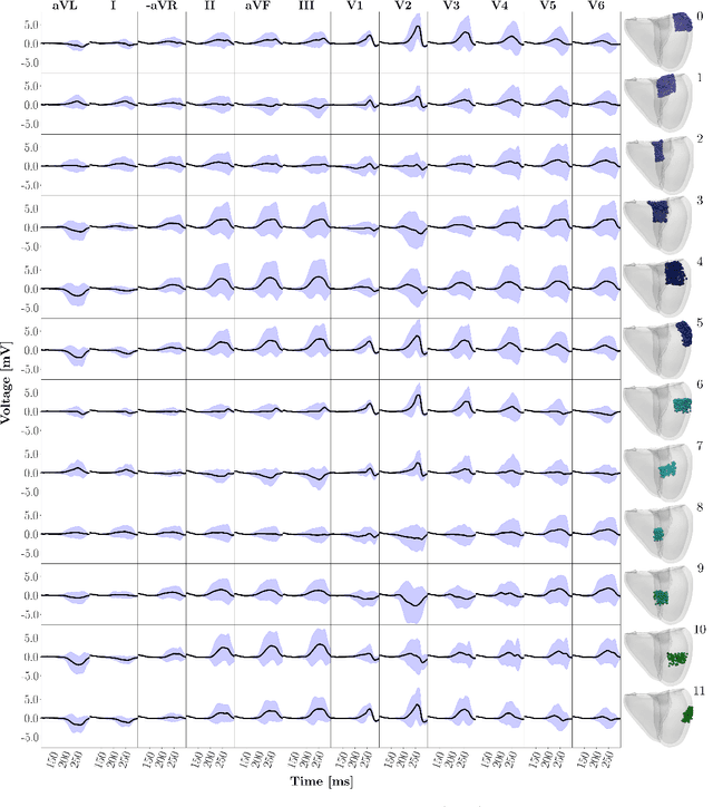 Figure 3 for Explainable Deep Learning-based Classification of Wolff-Parkinson-White Electrocardiographic Signals
