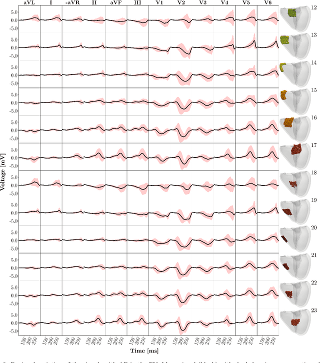 Figure 4 for Explainable Deep Learning-based Classification of Wolff-Parkinson-White Electrocardiographic Signals