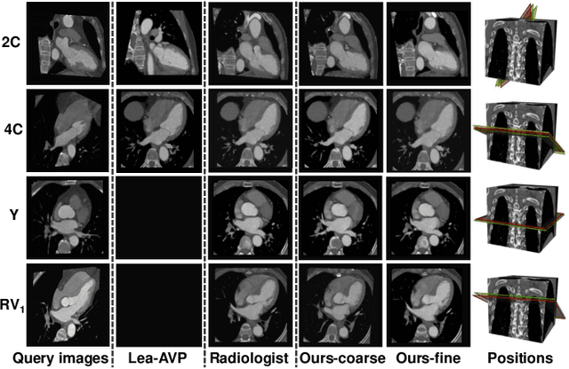 Figure 4 for AVP-AP: Self-supervised Automatic View Positioning in 3D cardiac CT via Atlas Prompting