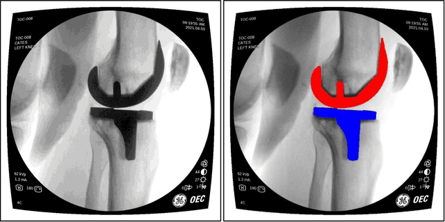 Figure 1 for An Automated Real-Time Approach for Image Processing and Segmentation of Fluoroscopic Images and Videos Using a Single Deep Learning Network