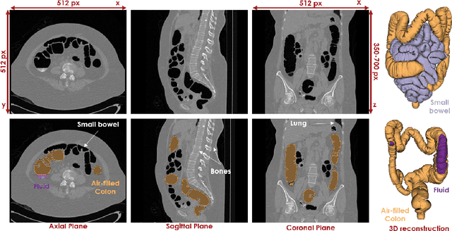 Figure 1 for HQColon: A Hybrid Interactive Machine Learning Pipeline for High Quality Colon Labeling and Segmentation