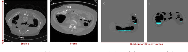 Figure 4 for HQColon: A Hybrid Interactive Machine Learning Pipeline for High Quality Colon Labeling and Segmentation