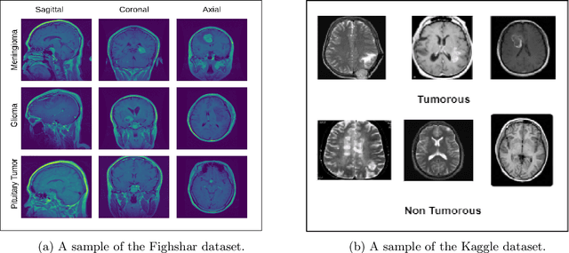 Figure 2 for Deep Fusion Model for Brain Tumor Classification Using Fine-Grained Gradient Preservation