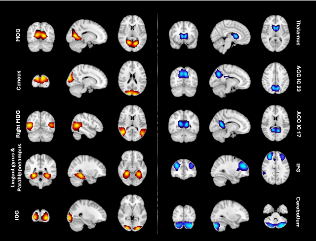 Figure 4 for Generative forecasting of brain activity enhances Alzheimer's classification and interpretation