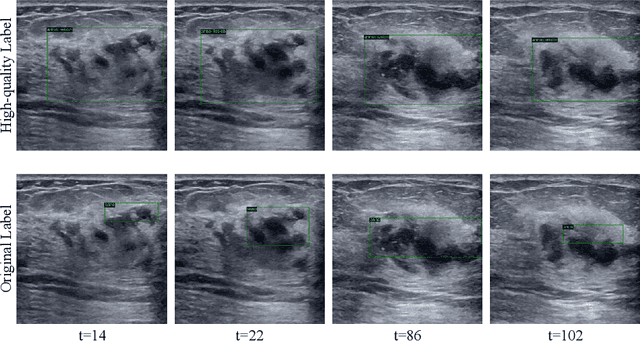 Figure 3 for Mining Negative Temporal Contexts For False Positive Suppression In Real-Time Ultrasound Lesion Detection