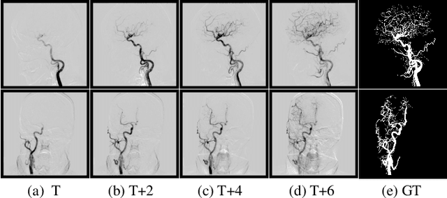 Figure 1 for TSI-Net: A Timing Sequence Image Segmentation Network for Intracranial Artery Segmentation in Digital Subtraction Angiography