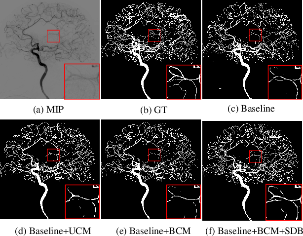 Figure 4 for TSI-Net: A Timing Sequence Image Segmentation Network for Intracranial Artery Segmentation in Digital Subtraction Angiography