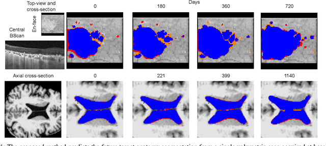 Figure 1 for Learning Spatio-Temporal Model of Disease Progression with NeuralODEs from Longitudinal Volumetric Data