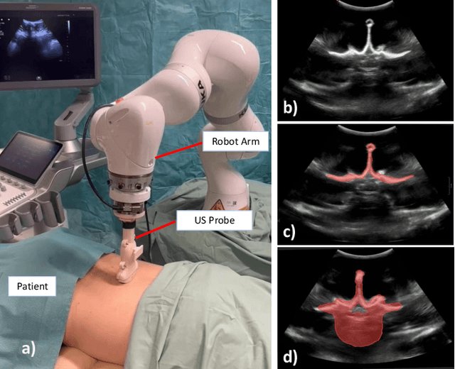 Figure 1 for Shape Completion and Real-Time Visualization in Robotic Ultrasound Spine Acquisitions