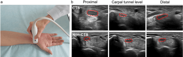 Figure 3 for One-Stop Automated Diagnostic System for Carpal Tunnel Syndrome in Ultrasound Images Using Deep Learning