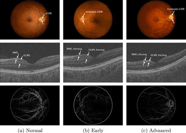 Figure 1 for ETSCL: An Evidence Theory-Based Supervised Contrastive Learning Framework for Multi-modal Glaucoma Grading