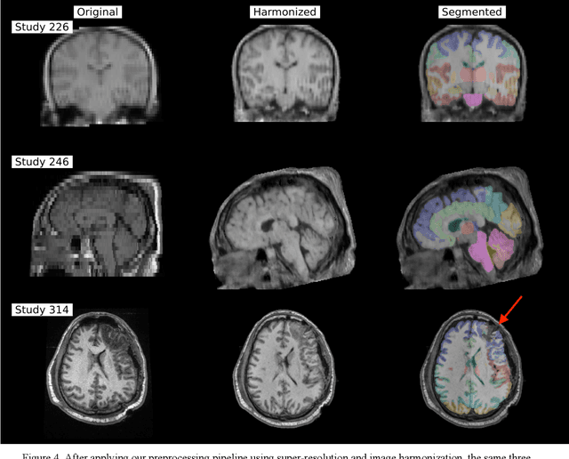 Figure 4 for Phenotype discovery of traumatic brain injury segmentations from heterogeneous multi-site data