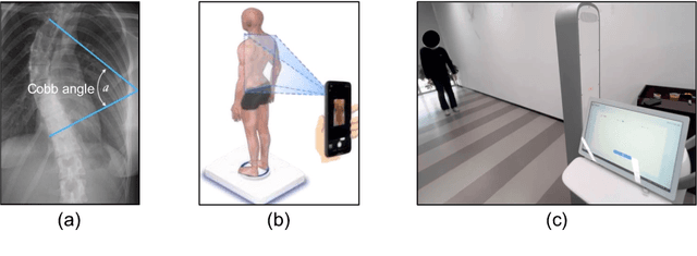 Figure 1 for Gait Patterns as Biomarkers: A Video-Based Approach for Classifying Scoliosis