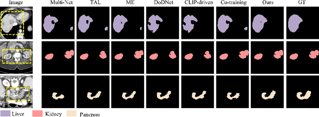 Figure 4 for Deep Mutual Learning among Partially Labeled Datasets for Multi-Organ Segmentation