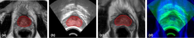 Figure 3 for Weakly Supervised Spatial Implicit Neural Representation Learning for 3D MRI-Ultrasound Deformable Image Registration in HDR Prostate Brachytherapy