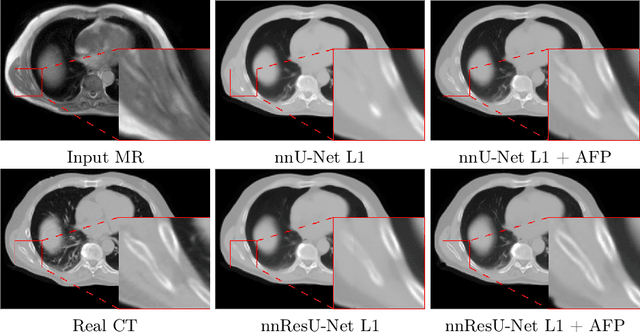 Figure 4 for Deep Learning-Based Cross-Anatomy CT Synthesis Using Adapted nnResU-Net with Anatomical Feature Prioritized Loss