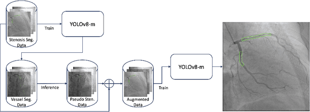 Figure 1 for SSASS: Semi-Supervised Approach for Stenosis Segmentation