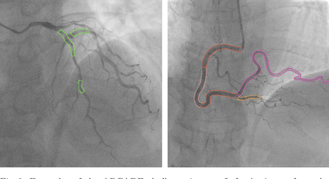 Figure 3 for SSASS: Semi-Supervised Approach for Stenosis Segmentation