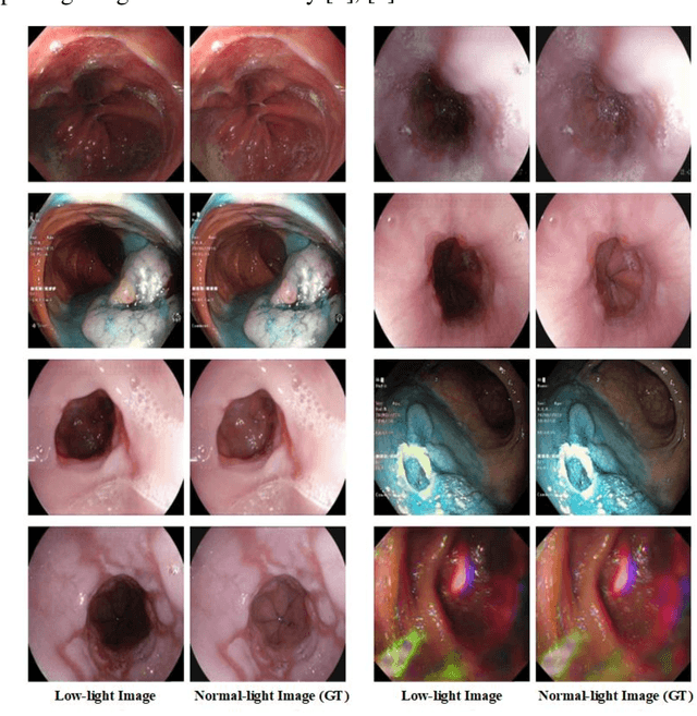 Figure 1 for BrightVAE: Luminosity Enhancement in Underexposed Endoscopic Images
