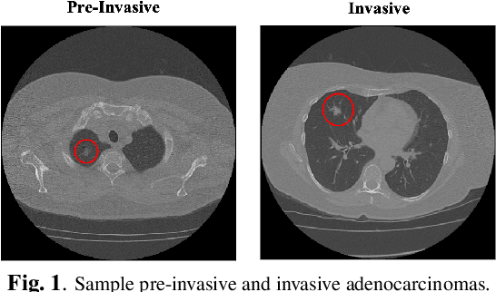 Figure 1 for Spatio-Temporal Hybrid Fusion of CAE and SWIn Transformers for Lung Cancer Malignancy Prediction