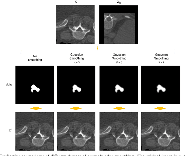Figure 3 for Harder synthetic anomalies to improve OoD detection in Medical Images