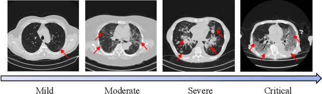 Figure 1 for Boosting COVID-19 Severity Detection with Infection-aware Contrastive Mixup Classification