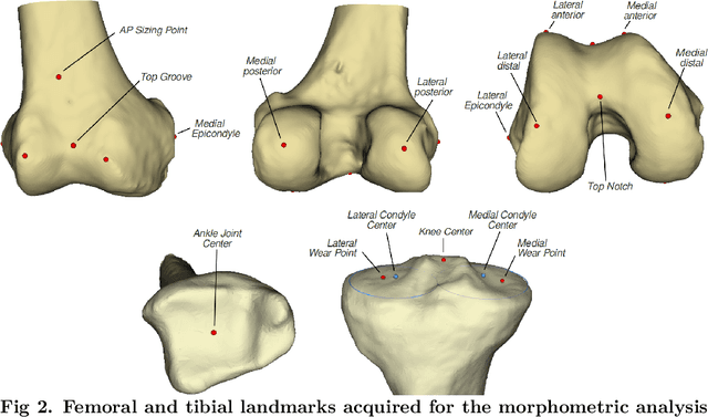 Figure 3 for Fully automated workflow for the design of patient-specific orthopaedic implants: application to total knee arthroplasty