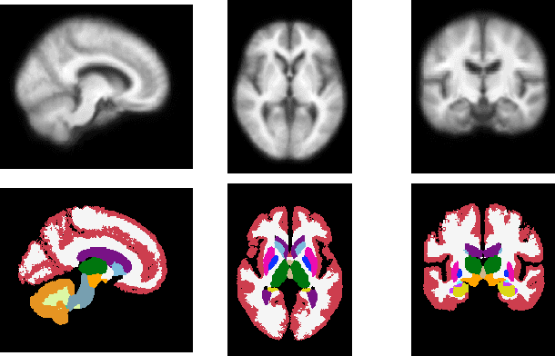 Figure 4 for AtlasMorph: Learning conditional deformable templates for brain MRI