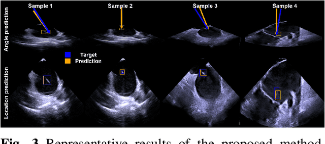 Figure 3 for Guidance for Intra-cardiac Echocardiography Manipulation to Maintain Continuous Therapy Device Tip Visibility