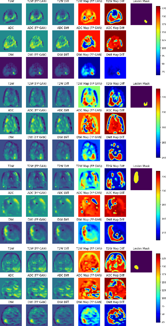 Figure 4 for Anomaly-Driven Approach for Enhanced Prostate Cancer Segmentation