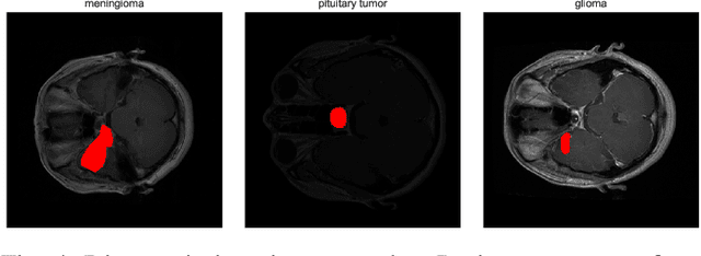Figure 4 for Brain Tumor Diagnosis Using Quantum Convolutional Neural Networks