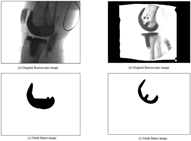 Figure 4 for Enhanced Knee Kinematics: Leveraging Deep Learning and Morphing Algorithms for 3D Implant Modeling
