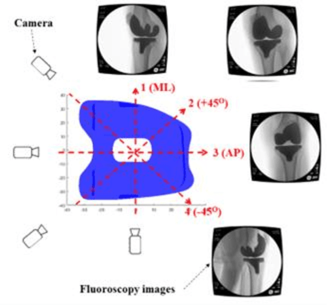 Figure 1 for Enhanced Knee Kinematics: Leveraging Deep Learning and Morphing Algorithms for 3D Implant Modeling