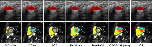Figure 3 for Cross Prompting Consistency with Segment Anything Model for Semi-supervised Medical Image Segmentation