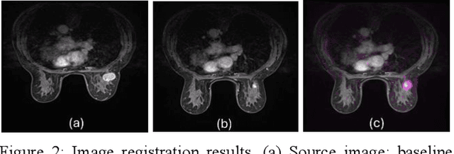 Figure 3 for Breast Cancer Neoadjuvant Chemotherapy Treatment Response Prediction Using Aligned Longitudinal MRI and Clinical Data