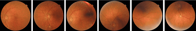 Figure 3 for Improving diabetic retinopathy screening using Artificial Intelligence: design, evaluation and before-and-after study of a custom development