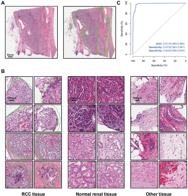 Figure 4 for Artificial intelligence for diagnosing and predicting survival of patients with renal cell carcinoma: Retrospective multi-center study