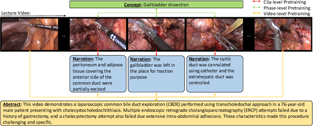 Figure 1 for HecVL: Hierarchical Video-Language Pretraining for Zero-shot Surgical Phase Recognition