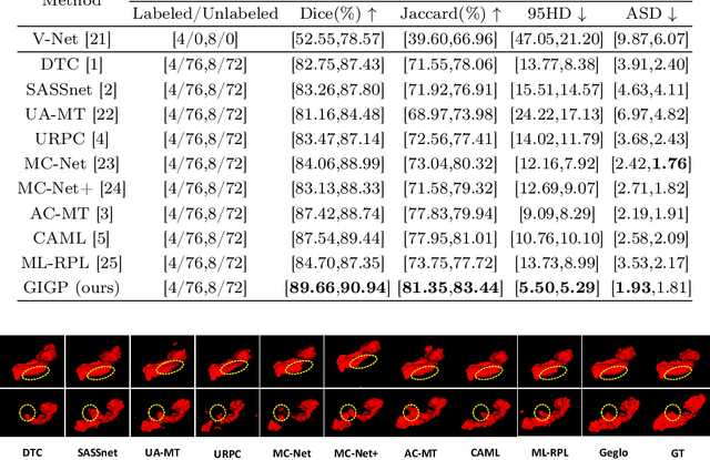 Figure 4 for GIGP: A Global Information Interacting and Geometric Priors Focusing Framework for Semi-supervised Medical Image Segmentation