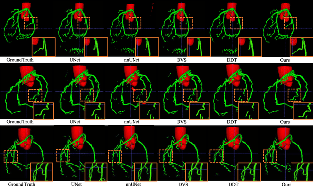 Figure 3 for Graph Convolution Based Cross-Network Multi-Scale Feature Fusion for Deep Vessel Segmentation