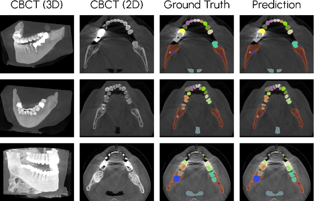 Figure 3 for Scaling nnU-Net for CBCT Segmentation