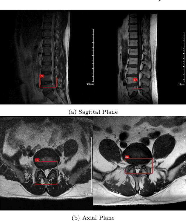 Figure 1 for Dual Attention Driven Lumbar Magnetic Resonance Image Feature Enhancement and Automatic Diagnosis of Herniation