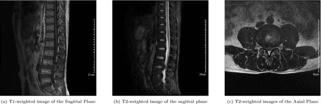 Figure 3 for Dual Attention Driven Lumbar Magnetic Resonance Image Feature Enhancement and Automatic Diagnosis of Herniation