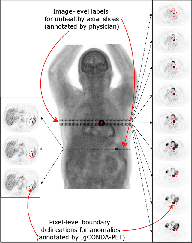 Figure 1 for IgCONDA-PET: Implicitly-Guided Counterfactual Diffusion for Detecting Anomalies in PET Images