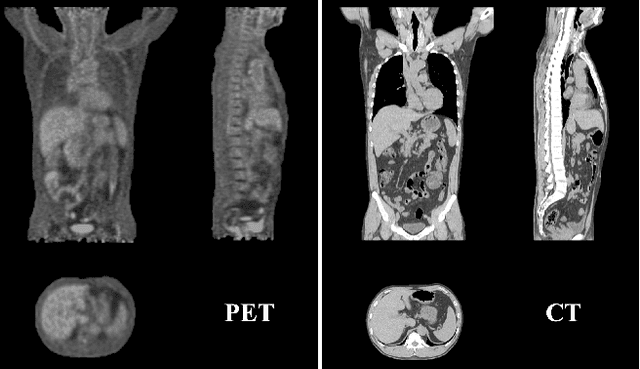 Figure 1 for SegAnyPET: Universal Promptable Segmentation from Positron Emission Tomography Images