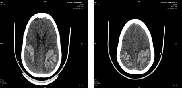 Figure 3 for 3D Convolutional Neural Networks for Improved Detection of Intracranial bleeding in CT Imaging